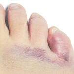 Consecuencias y cuidados tras sufrir un golpe en el dedo meñique del pie